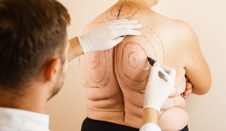 Male Liposuction: Trends and Growth in the UK Cosmetic Surgery Industry-